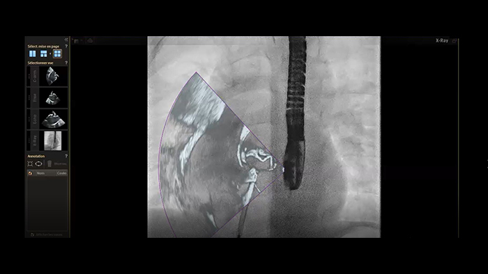Miniatura dotycząca systemu HeartNavigator